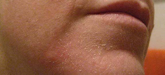 Sécheresse cutanée, comment agir ?